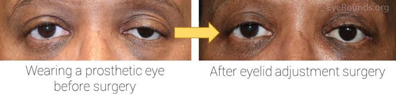 Examples of droopiness seen after the eye removal surgery, which is often corrected after a properly fitted prosthetic eye is worn (top). If the eye continues to be droopy, eyelid adjustment surgery can address the issue (bottom).