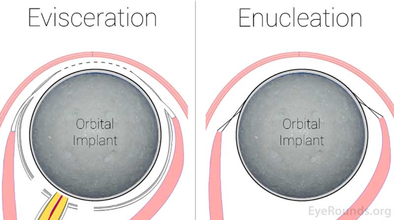 This graphic depicts the placement of the orbital implant into the eye socket after the patient's has been removed via either evisceration or enucleation.