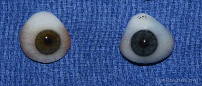 Examples of prosthetic eyes.