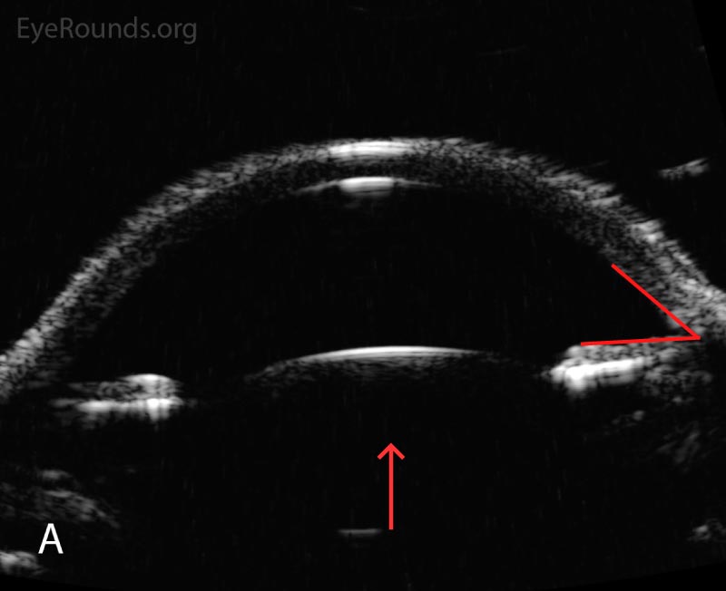 Anterior segment ultrasound of the anterior chamber (A) with attention focused to the ciliary body (B) at two-week follow-up. The anterior chamber is deep; the angle is open (red angle); the lens-iris diaphragm is flat (red arrow); and the ciliary body is no longer rotated anteriorly (red asterisk). The left eye had a similar appearance.