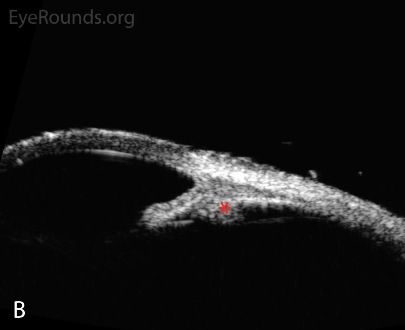 Anterior segment ultrasound of the anterior chamber (A) with attention focused to the ciliary body (B) at two-week follow-up. The anterior chamber is deep; the angle is open (red angle); the lens-iris diaphragm is flat (red arrow); and the ciliary body is no longer rotated anteriorly (red asterisk). The left eye had a similar appearance.