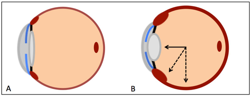 Anatomical alterations in topiramate-induced angle closure. The choroid and ciliary body are depicted in red, the zonules in black, the iris in blue, and the lens and cornea in gray. 5A represents normal ocular anatomy. 5B represents anatomical alterations that occur in this condition. The dashed arrows show ciliochoroidal swelling. The solid arrow indicates anterior displacement of the lens-iris diaphragm, spherical lens changes, and shallowing of the anterior chamber.