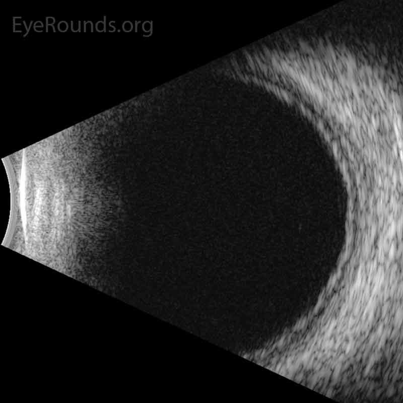 B-scan ultrasound, OD. There is a shallow choroidal effusion. The left eye had a similar appearance. 
