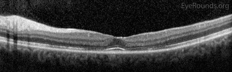 Optical Coherence Tomography (OCT) OD (upper image) and OS (lower image) two months after initial presentation. There was parafoveal thinning of the outer retina OU, but there was re-establishment of the inner segment/outer segment junction subfoveally OU.