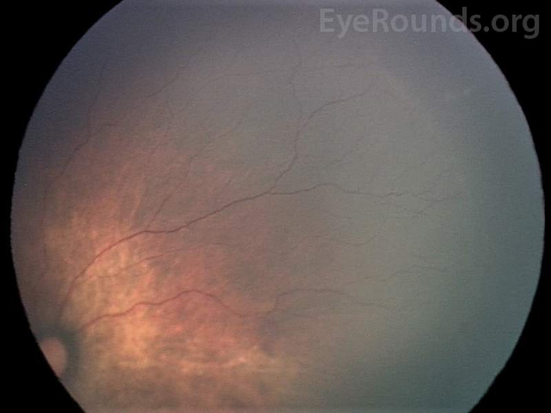 Fundus photo of stage 1 shows thin demarcation line (white arrows) that lacks dimensions and separates vascular retina from the avascular anterior.