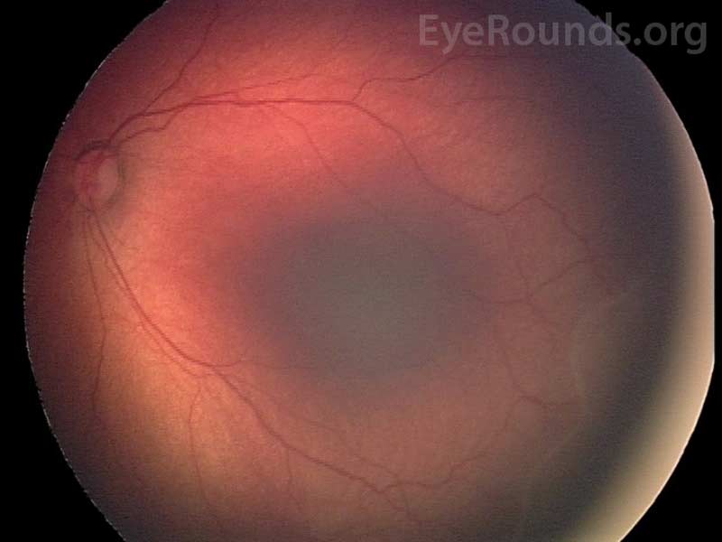 Fundus photo of stage 2 reveals a thickened ridge with dimension. There is vascular arcading of the retinal vessels immediately posterior to the ridge.