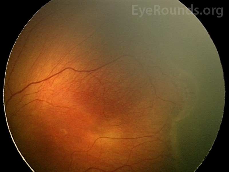 Fundus photo of stage 3 depicts a ridge with fibrovascular proliferation.