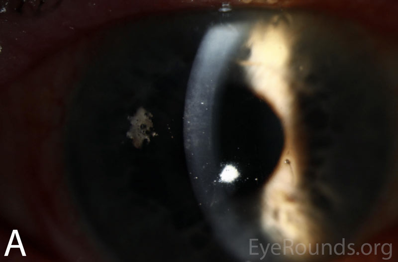 Slit lamp photographs of the right and left eyes at initial presentation. In both eyes, note diffuse epithelial haze and scattered punctate epithelial erosions.