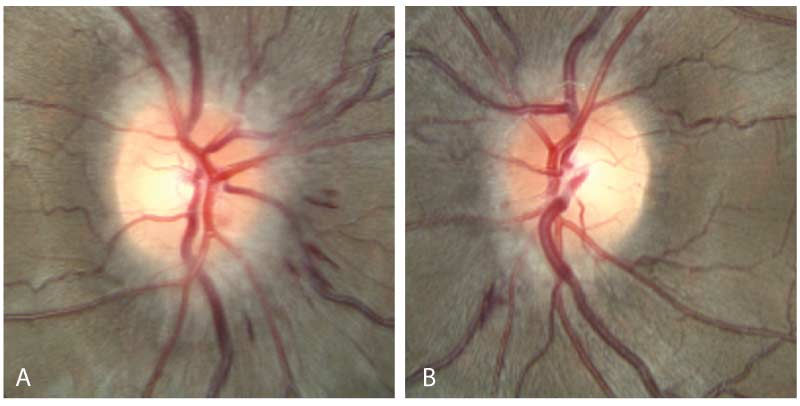 Fundus photography of the right eye (A) and the left eye (B) showing Grade 1 disc edema of both optic nerves characterized by a "C-shaped" halo with associated disc hemorrhages. There was no optic disc pallor in either eye. There were no peripapillary folds or coarsening of the retinal nerve fiber layer (RNFL) in either eye.