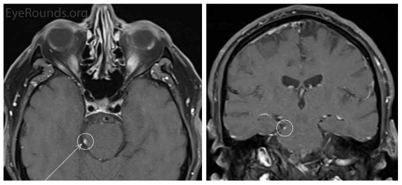 Axial and coronal brain MRI with and without contrast shows a small right fourth (trochlear) nerve lesion with enhancement adjacent to the midbrain in the peri-mesencephalic cistern. The lesion is approximately 5mm x 3mm. 