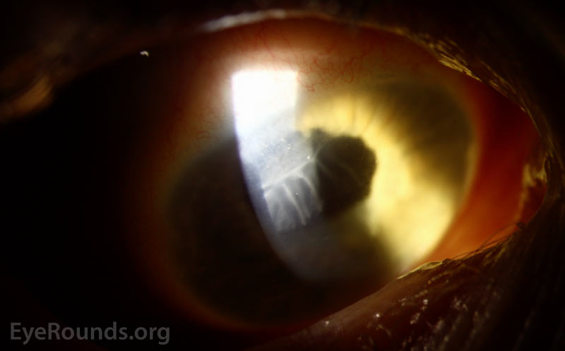 Color slit lamp photograph (broad beam) of the right eye demonstrating a grey sheet with scalloped edges extending along the endothelium with overlying mild corneal edema.