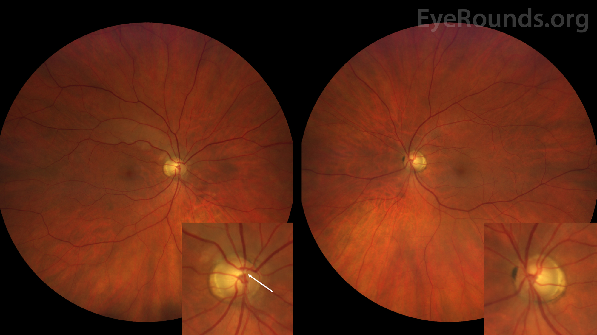 Symptomatic Branch Retinal Artery Occlusion An Under