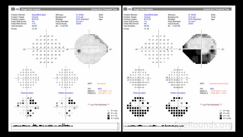 Visual field testing in both eyes demonstrated poor testing reliability.