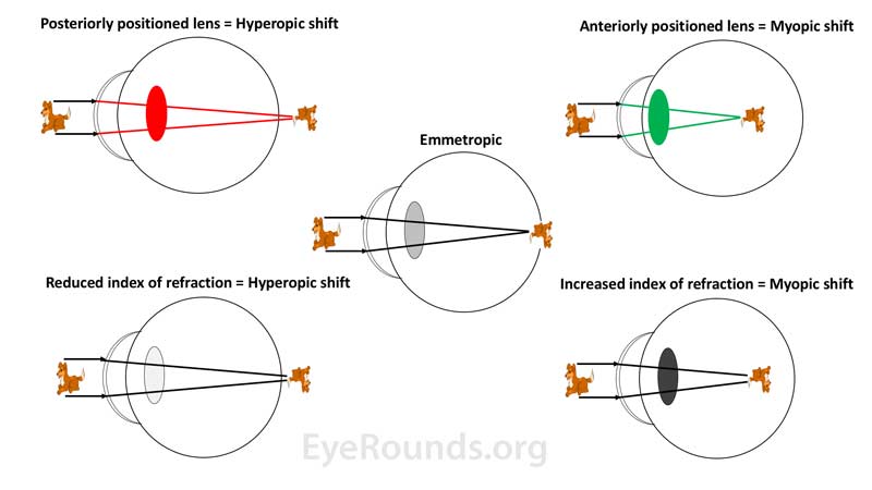 Hyperopic shifts (left side images) can occur if the lens is positioned too posteriorly or if there is a decrease in the refractive index of the lens. Myopic shifts (right side images) can occur if the lens is positioned too anteriorly or if there is an increase in the refractive index of the lens. 