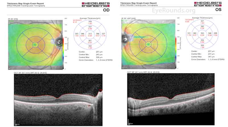 Optical Coherence Tomography Macula, both eyes