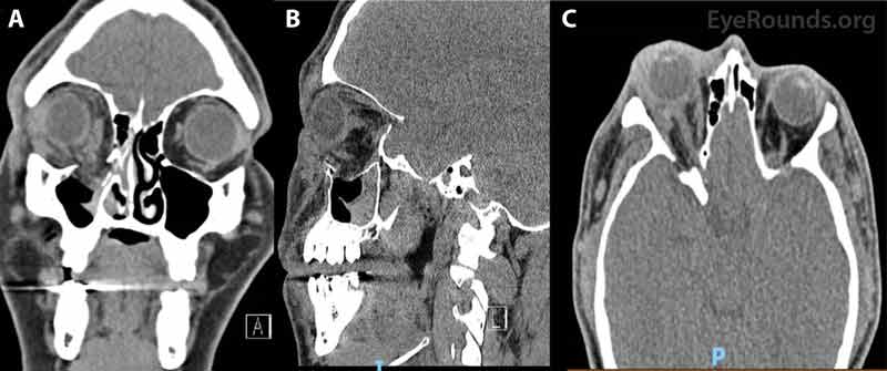 CT maxillofacial scan, Coronal view (A), Sagittal view (B), Axial view (C).