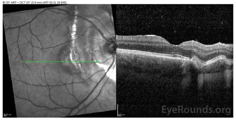 Optical coherence tomography (OCT) of the right eye after three monthly treatments with intravitreal anti-VEGF therapy.