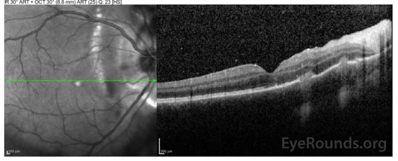 Optical coherence tomography (OCT) of the right eye that shows pre-retinal hyperreflective vitreous