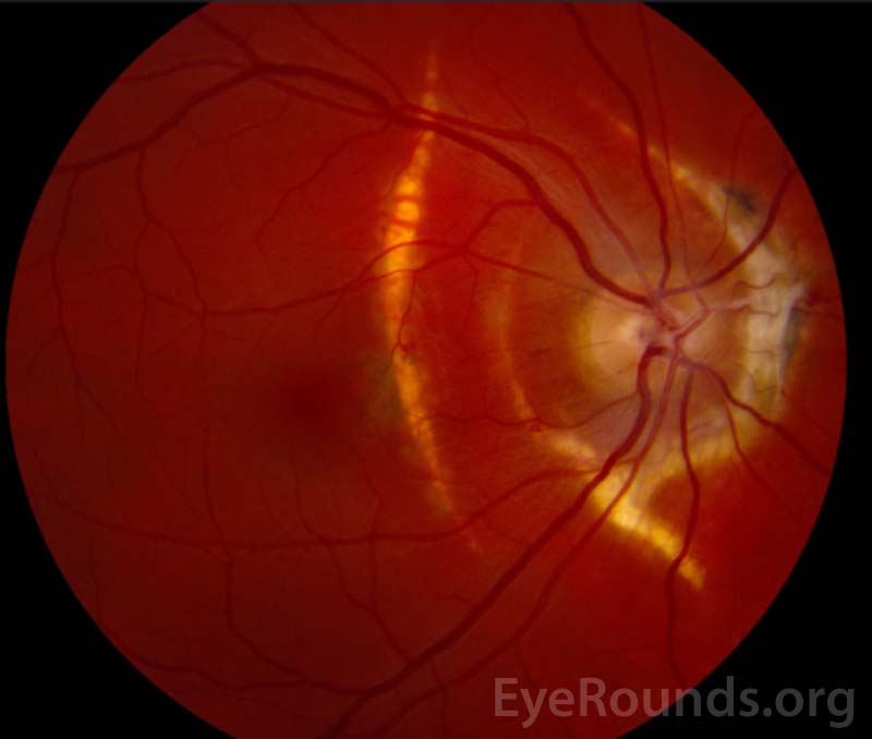 Color fundus photograph of the right eye four months after initial presentation.