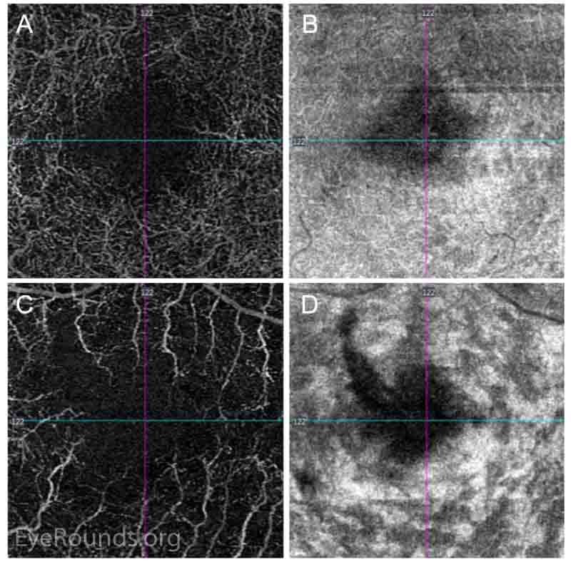 Optical coherence tomography angiography (3x3 mm) of the deep capillary plexus. There is relative preservation of the deep capillary plexus vasculature (A) in the right eye, with no abnormalities in the corresponding structural slab (B). In the left eye, there is profound flow loss (C), with corresponding hyperreflectivities on the structural slab (D). 