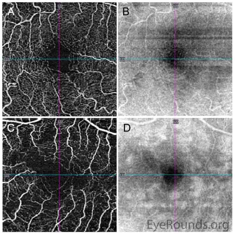 Optical coherence tomography angiography (3×3 mm) of the superficial capillary plexus. There is mild irregularity of the foveal avascular zone in the right eye (A, angiogram), with homogeneous reflectivity pattern on the corresponding en face structural slab (B). The left eye has an irregular foveal avascular zone with perifoveal vascular flow loss (C), and splotchy irregularity en face (D) corresponding to the hyperreflectivities seen on the OCT macula line scans in Figure 3.