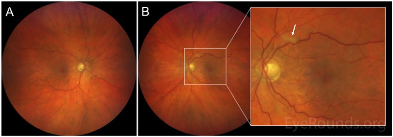 Color fundus photograph of (A) the right eye, which is unremarkable except for mild vascular tortuosity, and (B, inset: high magnification) the left eye, demonstrating a white lesion along the superior arcade representing a cotton wool spot (arrow) and faint grayish-white mottling in the temporal macula.