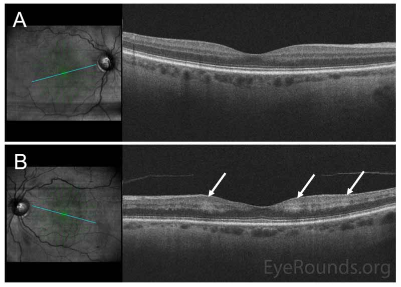 Spectral domain optical coherence tomography (SD-OCT) of the macula of (A) the right eye, showing intact retinal laminations, and (B) the left eye, demonstrating patchy perifoveal hyperreflectivity from the inner plexiform to the outer plexiform layers (arrows).