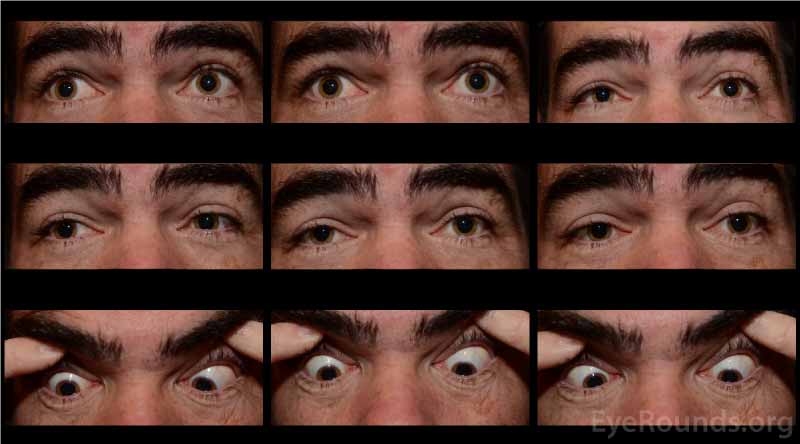  Nine-gaze eye motility photographs post-neostigmine testing at initial presentation