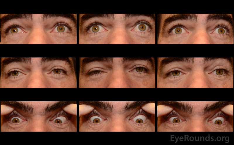  Nine-gaze eye motility photographs pre-neostigmine testing at initial presentation