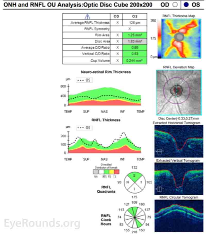  Spectral domain optical coherence tomography (SD-OCT) of the optic nerve head of the left eye