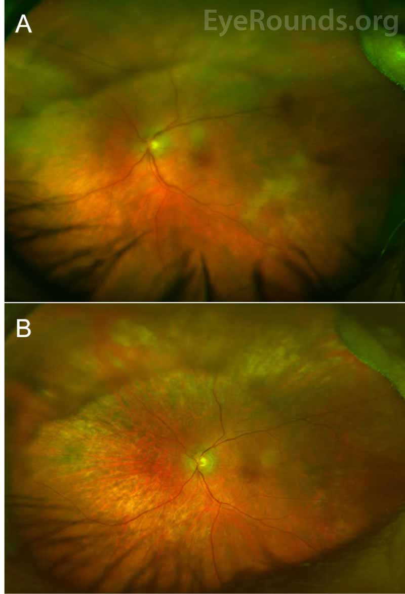  Color fundus photograph of the left eye 