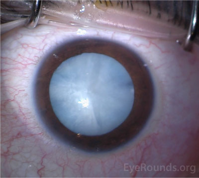   dense white cataract related to diabetes