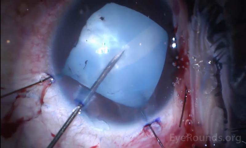  Image captured from intraoperative recordings demonstrating formation of Argentinian flag sign due to radial tear of the central capsule incision