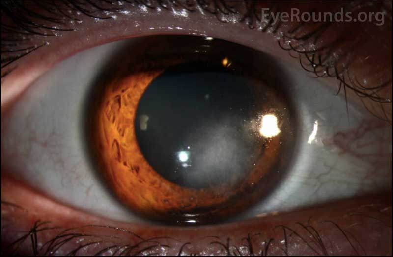 Anterior segment photography of the right eye at initial presentation showing inferonasal stromal opacification involving the visual axis.