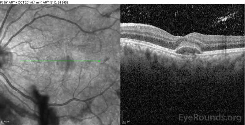  Optical coherence tomography of the macula