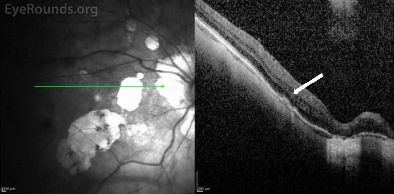  OCT macula three months following presentation after anti-VEGF therapy. The CNVM has resolved and there is some mild outer retinal atrophy in the area (arrow).
