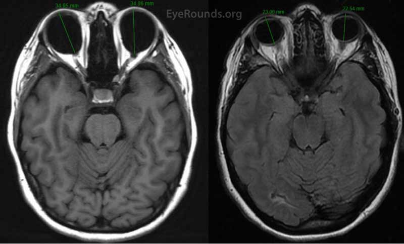  MRI of two patients. Patient A (left) has pathologic myopia and an elongated axial eye length that is obvious when compared to age and sex-matched Patient B (right) who has normal globes.
