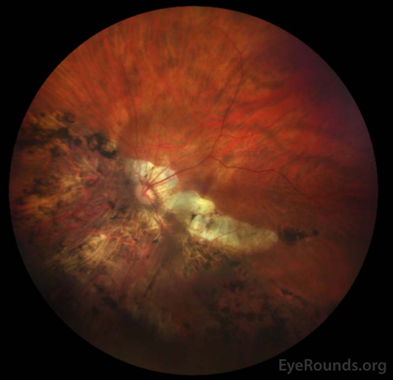  Clarus color fundus photograph of the left eye demonstrating signs of high myopia and prior retinal detachment. No retinal hemorrhages are present.