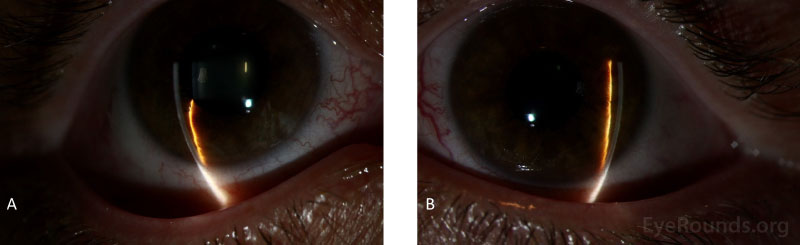 Anterior segment slit lamp photography of the right eye (A) and the left eye (B).