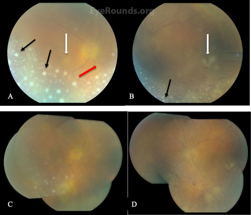  Color fundus photography of the right (A, C) and left eye (B,D)