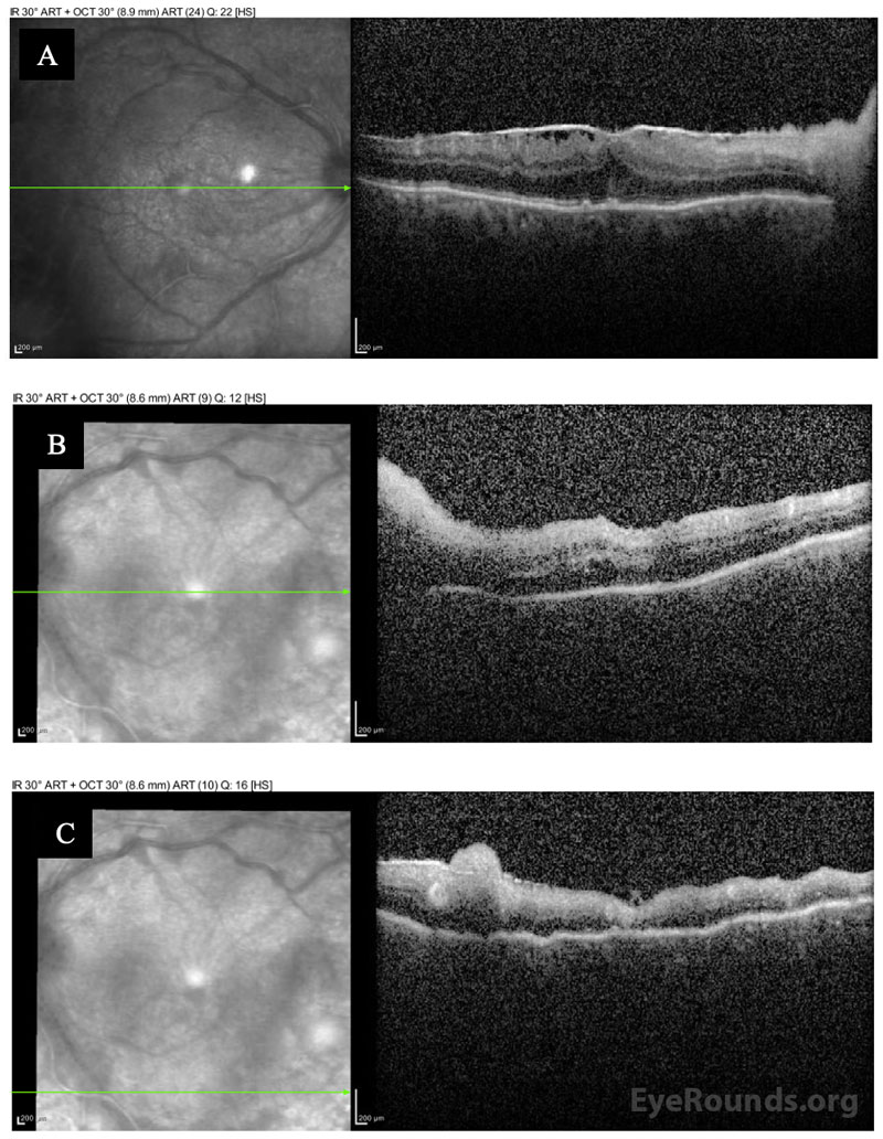 Optical coherence tomography of the right (A) and left (B, C) eyes on presentation.