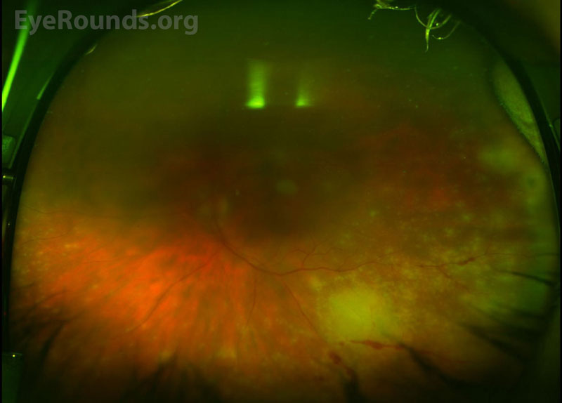  Optos color fundus photo of the left eye on presentation