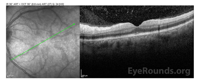 Optical coherence tomography (OCT) of the left eye.