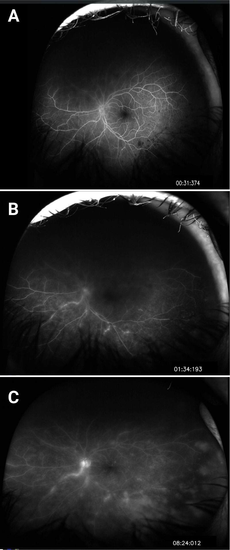 Optos Fluorescein Angiography of the left eye on presentation.