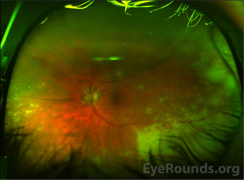 Optos fundus photography of the left eye 48 hours after initial presentation and intravitreal Foscarnet.