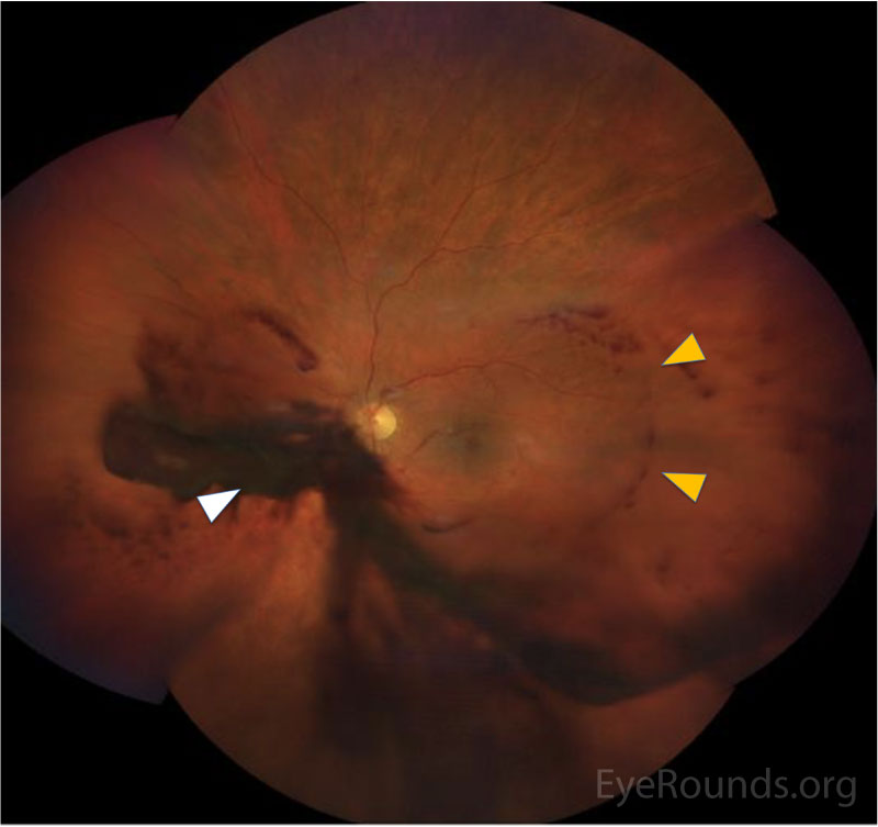 Montage wide-field fundus photograph of the left eye showing a dense vitreous hemorrhage overlying the inferior and nasal periphery 