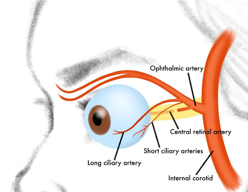 Montage wide-field fundus photograph of the left eye showing a dense vitreous hemorrhage overlying the inferior and nasal periphery 