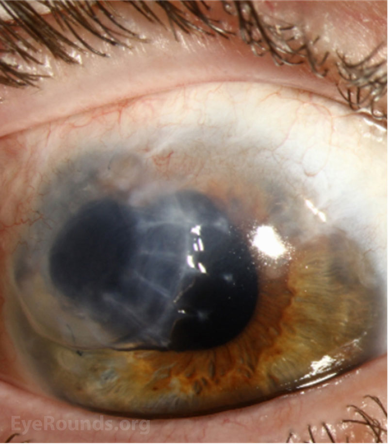 Slit lamp photograph of the patient's right eye