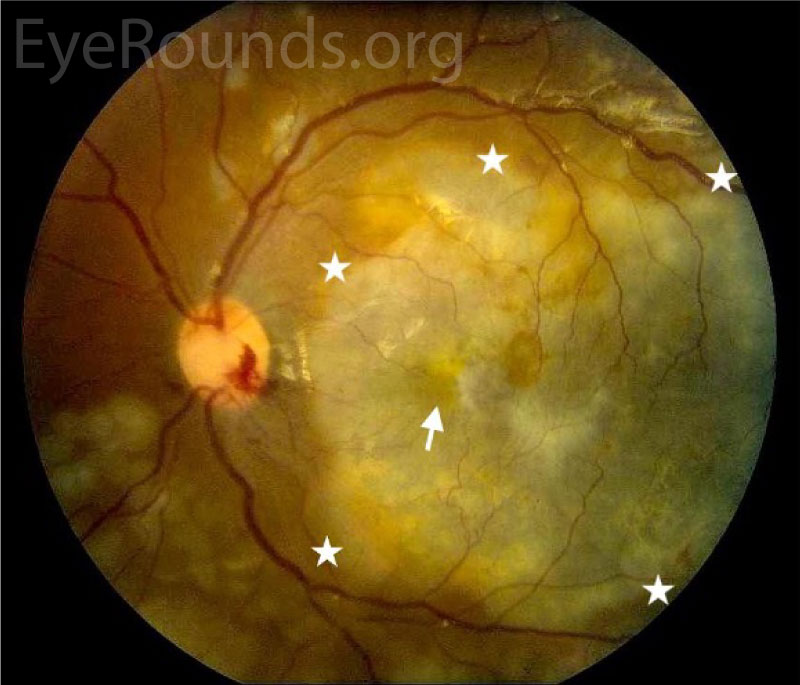 Clarus fundus photography of the left eye 1 week after initiating treatment