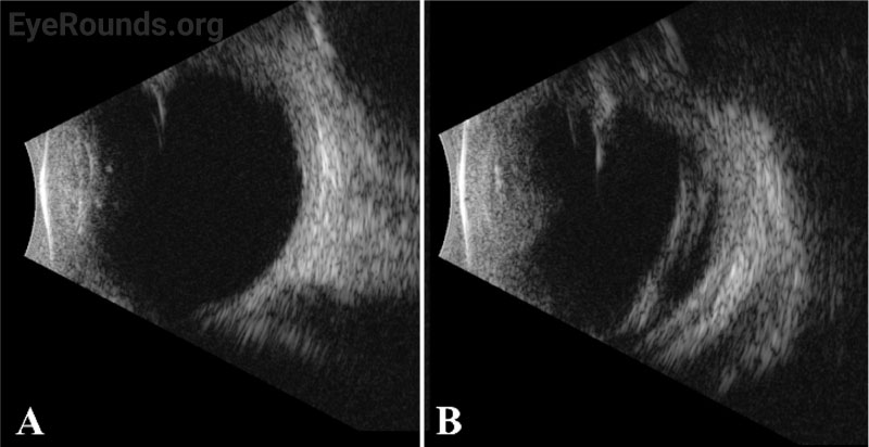 B-scan echography, right (A) and left (B) eyes.
